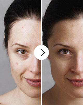 Ταμπλέτες για ακμή, σπυράκια και ατέλειες με ψευδάργυρο, βιταμίνη C, E και B2 Derminax_3 - 3