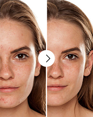 Ταμπλέτες για ακμή, σπυράκια και ατέλειες με ψευδάργυρο, βιταμίνη C, E και B2 Derminax_2 - 2