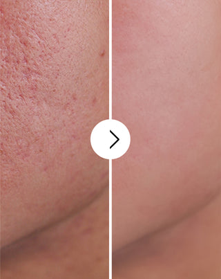 Ταμπλέτες για ακμή, σπυράκια και ατέλειες με ψευδάργυρο, βιταμίνη C, E και B2 Derminax_4