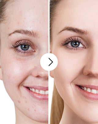 Ταμπλέτες για ακμή, σπυράκια και ατέλειες με ψευδάργυρο, βιταμίνη C, E και B2 Derminax_5 - 5