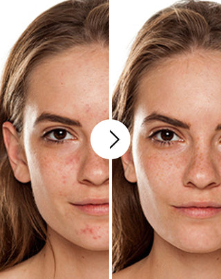 Ταμπλέτες για ακμή, σπυράκια και ατέλειες με ψευδάργυρο, βιταμίνη C, E και B2 Derminax_2 - 2